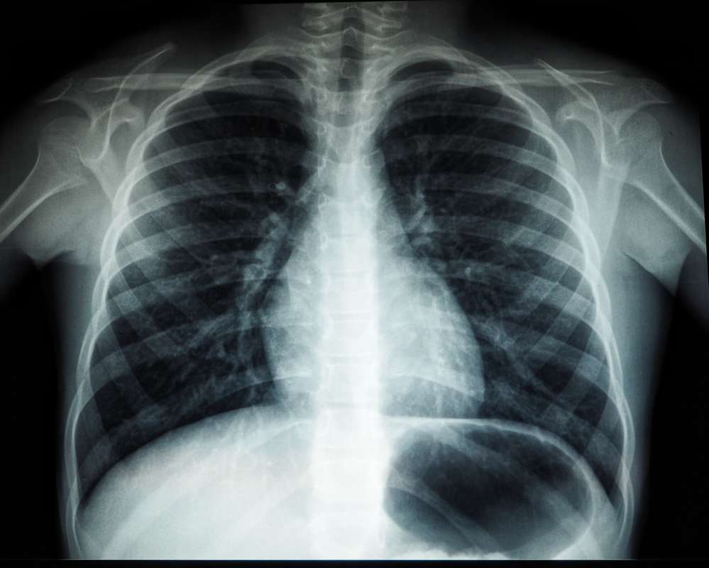 Chest X-Ray Image